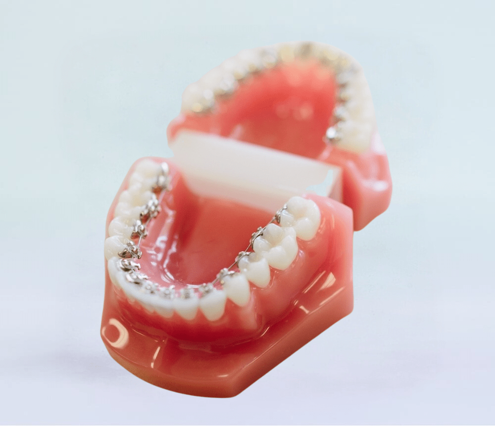 lingual braces on plastic model